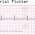 Flutter Rhythm EKG