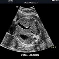 Stomach Ultrasound