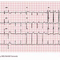 EKG