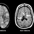Brain MRI Contrast