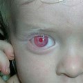 Albinism Red Eyes