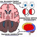 Cerebral Artery Stroke