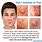 Cystic Acne Causes
