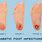 Diabetic Foot Sepsis