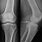 PCL Avulsion Fracture
