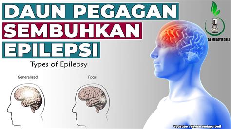 Pengobatan epilepsi