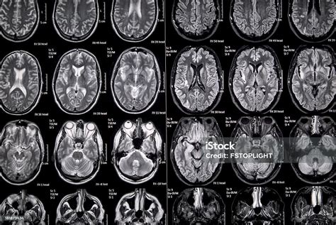 gambar otak hasil MRI