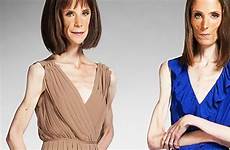anorexic twin doctors