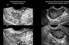 pcos ovary polycystic syndrome ovarian cysts symptomen policistico ovaio symptoms diagnosis menstrual numerous ovulating