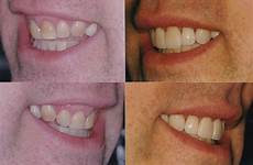 surgery osseous crown before after lengthening smile