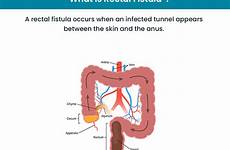 fistula rectal causes symptoms treatment diagnosis