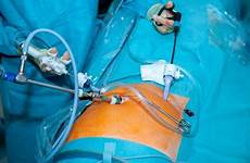 laparoscopy hysterectomy laparoscopic gynaecological incisions keyhole abdomen pelvis indications 10mm