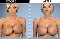 botched before after breast implants tits fake plastic pornstars patients james kimber augmentation pornstar transgender afters shocking blowing mind check