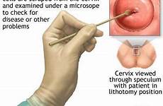 pap smear cancer test procedure cervical screening normal cells precancerous health types inexpensive relatively easily cancerous detect conditions simple microscope