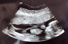weeks 19 pregnant twins ultrasound week pregnancy twin belly twiniversity