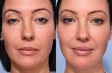 filler before after temple face resting dermal facelift tch women why temples liquid paying thousands removed frown angry facial their