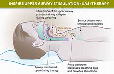 inspire sleep apnea treatment osa tongue stimulator airway upper stimulation implant nerve implanted device mild therapy implants cpap procedure implantation