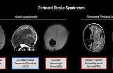 stroke perinatal neonatal mri ischemic neuroimaging arterial neurology disorder cumming nais