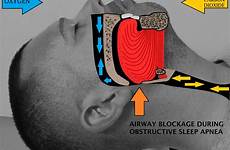 apnea airway snoring breathing