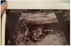 pregnant ultrasound twiniversity