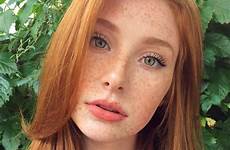 freckles