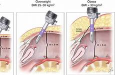 anatomy laparoscopic abdominal principles surgeon wall anterior basic fig effect