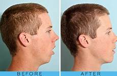 mouth breathing before after ugly breather nose makes example patient beautiful