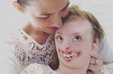 her syndrome sophia rett facial deformities girl disorder brain weaver has natalie passed disfigured who died away death rare due
