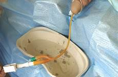 catheter urethral male catheterisation play gently resistance felt pull until bladder foreskin opening reposition