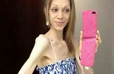 anorexic anorexia transformation nicola thinnest fought swns anoréxica culturista culturismo campeona morir waitress illness plummeted brink