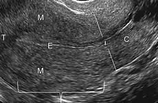 ultrasound uterus transvaginal transabdominal uterine bladder fundus urinary pelvic abdominal ovary adnexa cervix simulation scenarios pelvis tvs isthmus