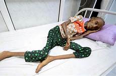 yemen famine emaciated astutenews malnutrition hunger embarrassed negotiations calls finally