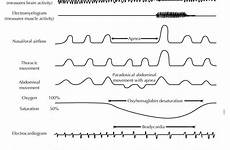 sleep polysomnogram psg respiratory scoring events hypopnea flow criteria modules thoracic aasm studies definition clinical professionals resources interpreting