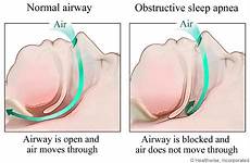 sleep apnea obstructive do airway treatment snoring osa cpap severe jaw health blocked side topics throat head breathing tmj teeth