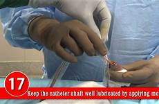 urethral male catheterization