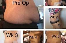 tummy tuck after before abdominoplasty reviews