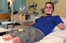 limbs lewis alex lips lost flesh eating who face his surgery bug four young father man has without bacteria amputee