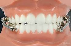 braces herbst appliance orthodontic private adult
