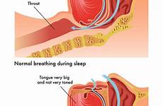 apnea obstructive schnarchen osa snoring airway snore tun mund obstruction cpap ursachen ostruttiva sonno geschlossenem disorder rob3000 fotosearch leukemia thesleepjudge