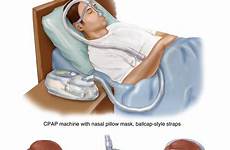 apnea sleep cpap machine mask airway positive pressure nasal australia continuous causes snoring treat fit pillows machines pursued choices cannot