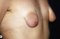 puffy areolas malformed