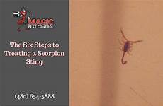 scorpion sting treating steps six stung healthy child adult who