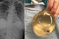 implant implants deflects doctors womans hkt gmt 1731 sage