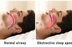 sleep apnea obstructive dentist airway causes normal vs help racing heart osa waking breathing treatments sleeping va 123dentist types disease