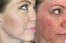 microneedling microdermabrasion acne does skin dermaplaning scars womensblogtalk scar enzyme till treatments procedure dermaroller repair invasive