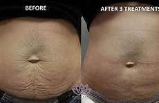 after before tummy mommy skin laser revive stomach ca loose treatment jun team results