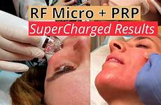 facial vampire prp scars acne mega results micro
