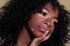 girl hair beautiful vitiligo pretty baddies girls skin melanin choose board curly people beauty