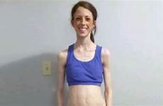 anorexic severely intervention