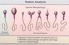 semen analysis male sperm causes infertility fertility normal if morphology shape ivf pregnancy step shaped fertilization motility
